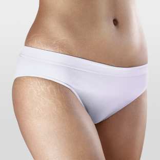 GUAM Duo Creme zur Behandlung von Dehnungsstreifen